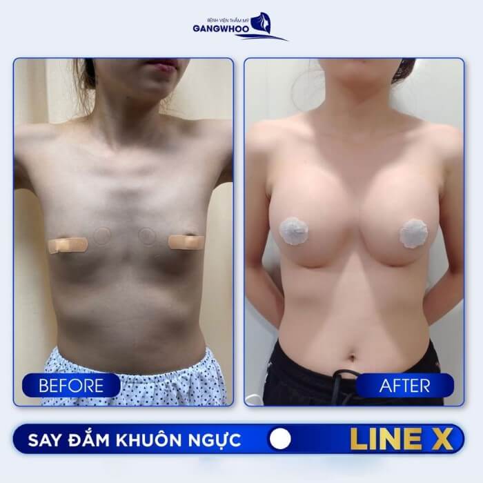 Nâng Ngực Ăn Kiêng Bao Lâu? - BS Hướng Dẫn Chăm Sóc Sau Nâng Ngực