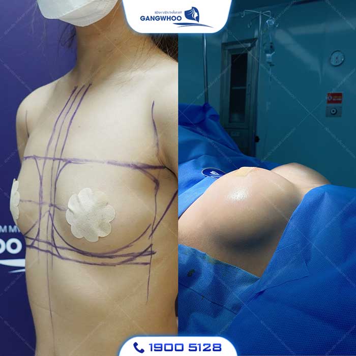 Nâng Ngực Ăn Kiêng Bao Lâu? - BS Hướng Dẫn Chăm Sóc Sau Nâng Ngực