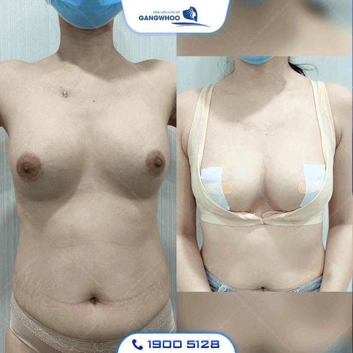 Nâng Ngực Ăn Kiêng Bao Lâu? - BS Hướng Dẫn Chăm Sóc Sau Nâng Ngực