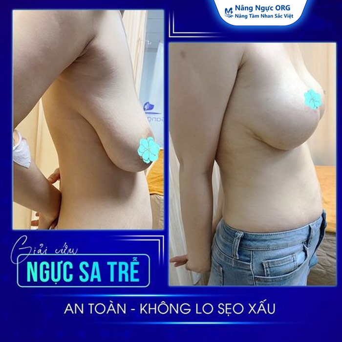Treo ngực sa trễ có để lại sẹo không?