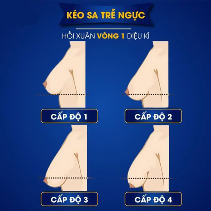 Treo ngực sa trễ có để lại sẹo không? Các cấp độ sa trễ ngực