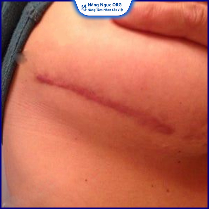 Sẹo sau khi thực hiện treo sa trễ ngực có hết không?