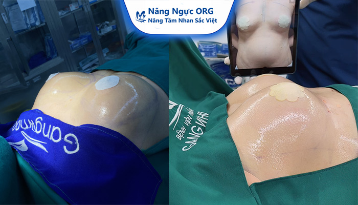 Nâng ngực bao lâu thì lành - 24 giờ đầu tiên sau nâng ngực